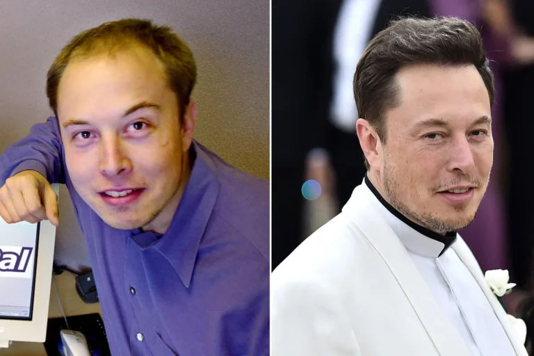 Elon Musk Before Hair Transplant: Exploring His Hair Loss Story