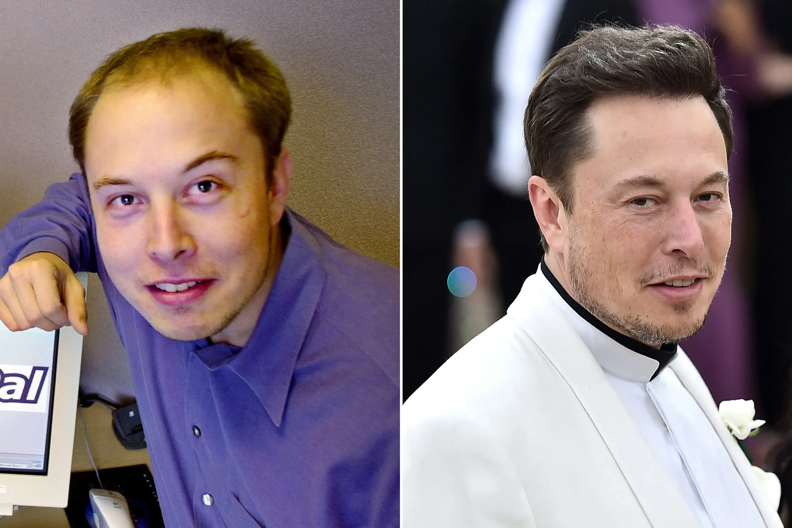 Elon Musk Before Hair Transplant: Exploring His Hair Loss Story